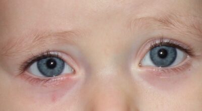 Oftalmologia Pediatrica