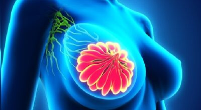 Formazione sul carcinoma mammario