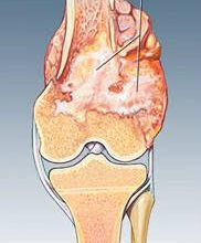 Ortopedia oncologica